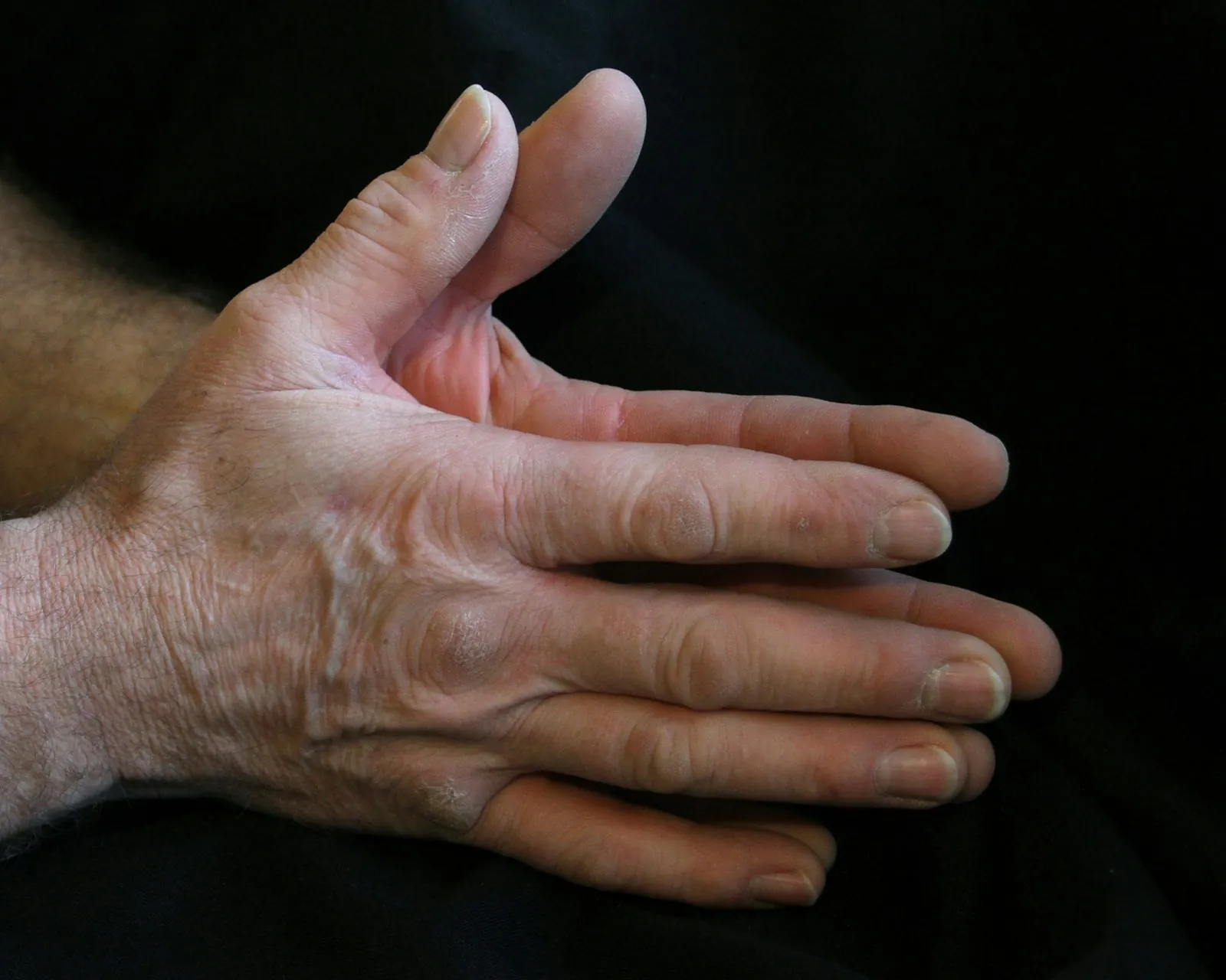 Neuropathy in hands and upper extremities treatment at BioWave Regeneration Houston TX